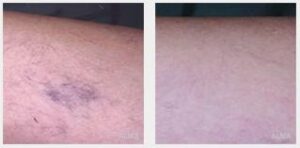 Red and Blue Vein Removal Treatments, Facial Vein, Leg Vein Removal in  Cardiff, South Wales, UK