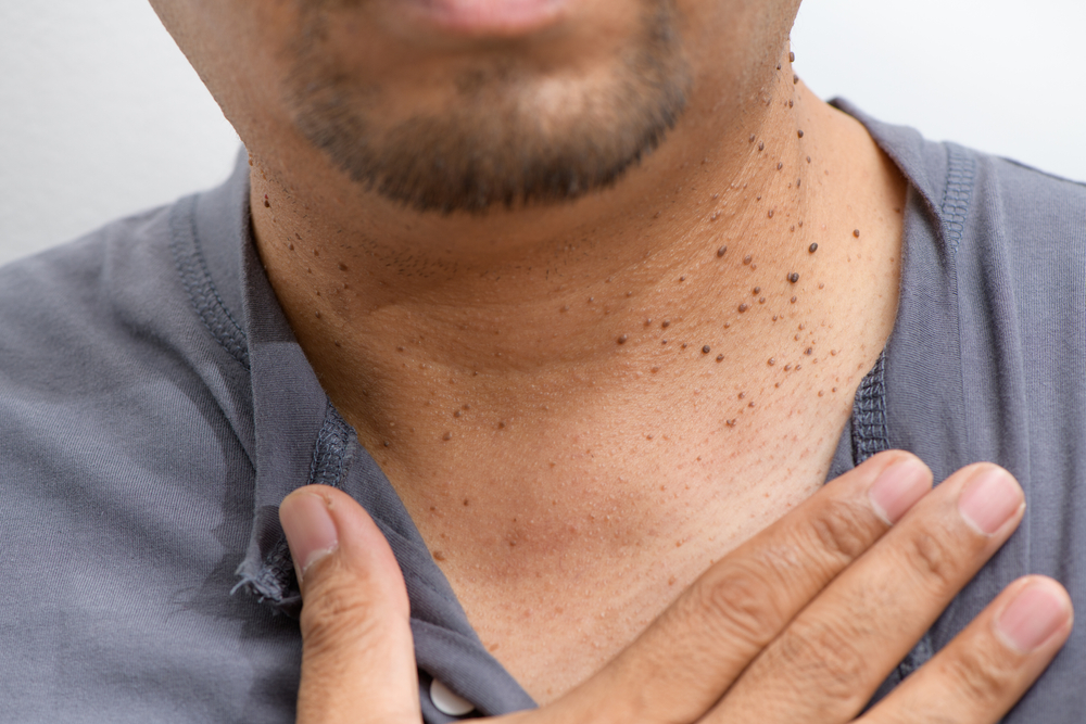 Are skin tags dangerous