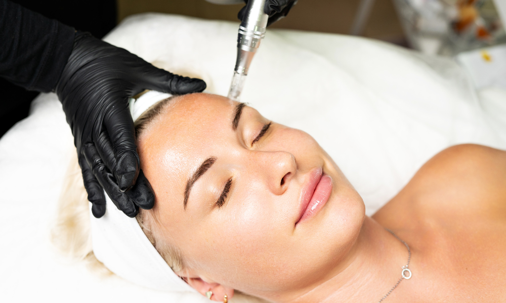 microneedling