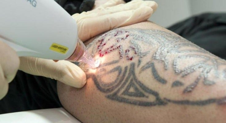The Do’s and Don’ts of Laser Tattoo Removal Treatment