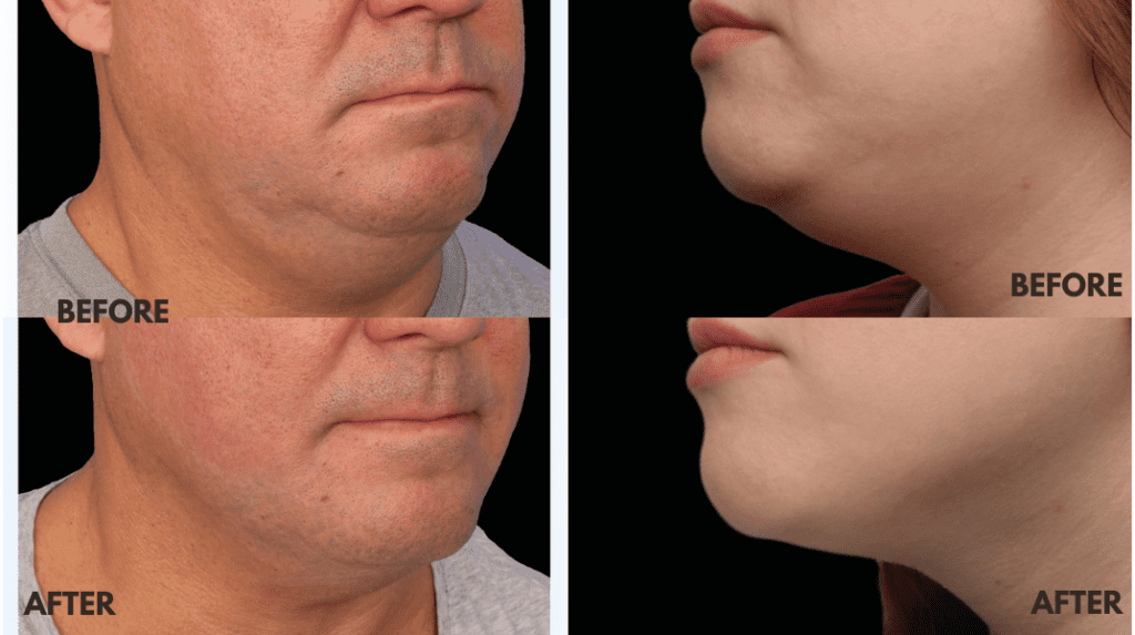 Are you seeking a non-invasive solution to redefine your facial contours and eliminate under-chin fat? Look no further than EmSubmentum, a revolutionary treatment that forms part of the EmFamily Range. Specifically designed as part of EmFace, EmSubmentum offers sculpting and lifting benefits, providing remarkable anti-aging results while lifting the muscles under your chin and reducing the appearance of a double chin. Understanding EmSubmentum EmSubmentum is a cutting-edge procedure within the EmFamily Range, developed to target under-chin fat and double chins without the need for surgery or invasive treatments. As a key component of EmFace, this innovative treatment offers comprehensive sculpting and lifting benefits, helping you achieve a more youthful and defined jawline. How It Works Utilising advanced technology, EmSubmentum effectively targets stubborn fat cells beneath the chin while simultaneously lifting and tightening the underlying muscles and skin. By addressing every layer from muscle to skin, this non-invasive approach ensures optimal results without the need for needles or toxins. With EmSubmentum, you can enjoy a pain-free experience with zero downtime, making it the ideal choice for those seeking a convenient and comfortable solution for facial contouring. EmSubmentum Before and Afters Key Benefits of EmSubmentum Non-Invasive: EmSubmentum provides a non-invasive alternative to surgical procedures, offering a safer and more comfortable experience for patients. Comprehensive Sculpting: As part of the EmFace range, EmSubmentum offers comprehensive sculpting and lifting benefits, targeting under-chin fat while smoothing fine lines and wrinkles for a rejuvenated appearance. Pain-Free: Say goodbye to discomfort! EmSubmentum is virtually pain-free, allowing you to undergo treatment with ease and confidence. Zero Downtime: With EmSubmentum, there’s no need to worry about downtime or recovery periods. You can return to your daily activities immediately after treatment, enjoying the convenience of a non-disruptive procedure. Transform Your Profile with EmSubmentum Whether you’re concerned about a double chin or seeking to enhance your facial contours, EmSubmentum offers a reliable solution that delivers impressive results. By harnessing the power of the EmFace, this innovative treatment provides anti-aging benefits and addresses various aesthetic concerns, helping you achieve the confident, youthful appearance you desire. For more information on EmFace, click here to head over to the page on our website. Ready to redefine your facial contours and embrace a more sculpted jawline? Schedule a consultation with us, we’ll give you a treatment plan and transform your profile, rejuvenating your appearance and diminishing your double chin with the EmSubmentum.