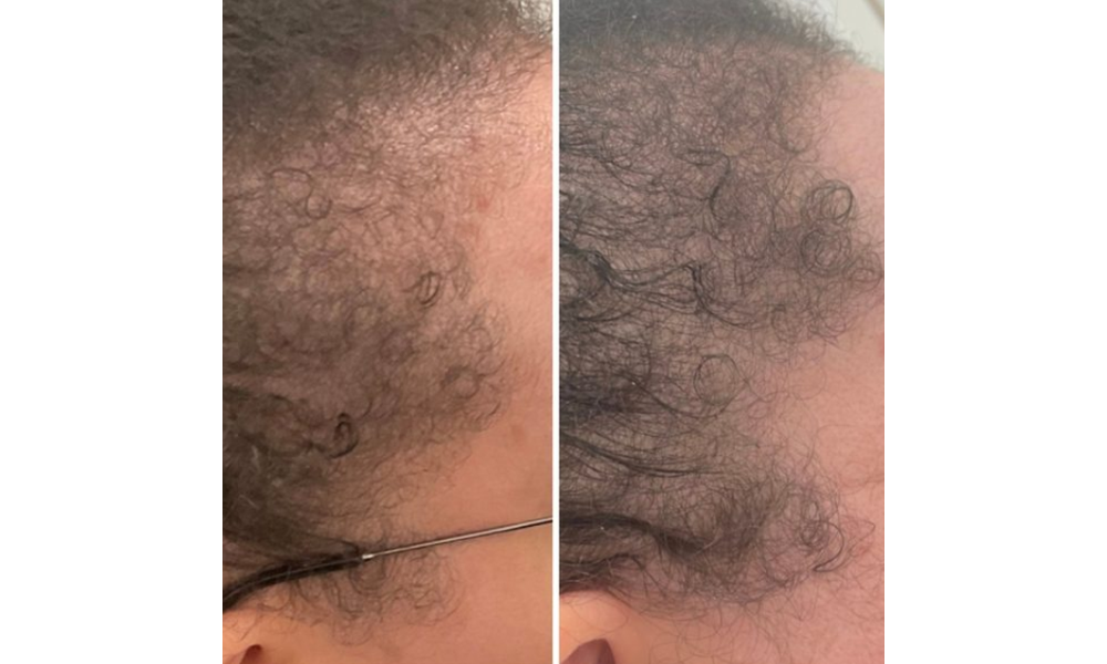 female and male hair loss