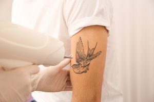 Tattoo Removal: What to Expect and How to Prepare