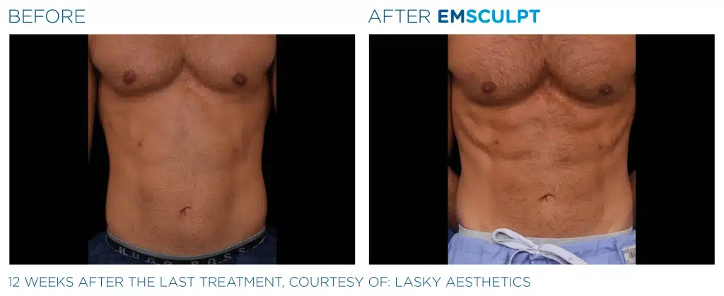 Before and after Emsculpt NEO abdomen treatment.