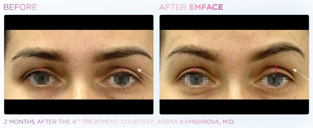 Before and after EMFACE results showing lifted brow and reduced under-eye hollowing two months after the fourth treatment